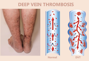 Dvt Inventions Deep venous thrombosis (DVT) treatment by IVC filter placement ...